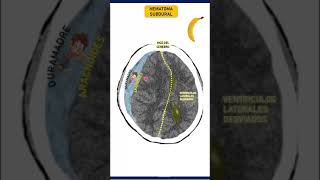 HEMATOMA SUBDURAL  HEMATAMOS INTRACRANEALES  Medicina en 1 minuto Shorts [upl. by Loreen]