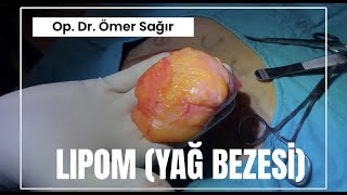 Yağ Bezesi Lipoma Nedir Yağ Bezesi Nasıl Geçer [upl. by Nipahc]