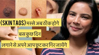 How to remove skin tags  मस्से की समस्या  easy solution of removing skin tags black spots [upl. by Oivlis]