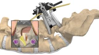 MAS® TLIF Patient Animation [upl. by Hsitirb]