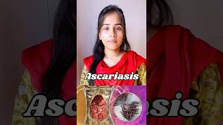 Ascariasis  protozoan disease🦠causes symptoms  transmission ascaris neet biology shortvideo [upl. by Assyla]