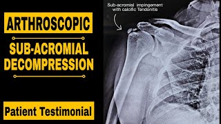 ARTHROSCOPIC SUBACROMIAL DECOMPRESSION PATIENT TESTIMONIAL [upl. by Rattan]