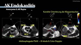 〖Echokardiografie〗 Aenurysma der Aortenklappe bei Endokarditis 😱 [upl. by Izmar477]