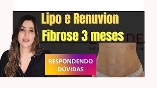 DÚVIDAS Lipo HD e Renuvion fibroses após 3 meses da Lipoaspiração [upl. by Tatianna]