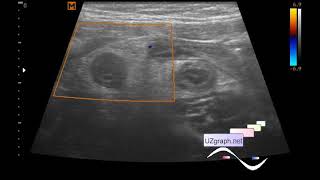 Ecografía abdominal pediátrica apendicitis flemonosa aguda omentitis [upl. by Scottie]