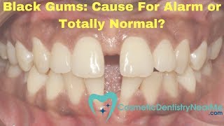 Black Gums Sign of a Problem or Completely Normal [upl. by Saenihp574]