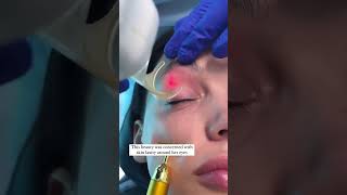 Co2 Laser Skin Resurfacing for Eyelids  Skin Tightening [upl. by Nnylaf]