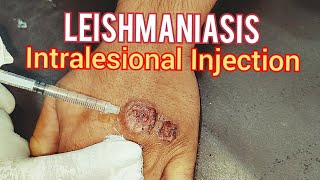 Leishmaniasis Treatment [upl. by Laeira]