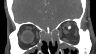 Carotid Cavernous Fistula [upl. by Acimat]