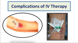 Complications of IV Therapy [upl. by Aima397]