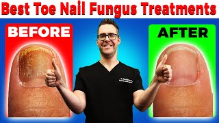 Best Toe Nail Fungus Treatments Onychomycosis Remedies [upl. by Nnav]