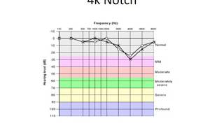 Sensorineural Hearing Loss  SNHL  ENT Lecture Series [upl. by Atteuqehs561]