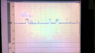 BKCa Single channel recording [upl. by Ramberg227]