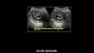 Ultrasound of the first trimester Part 2 Level 1 [upl. by Viafore]