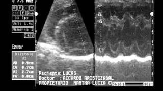 insuficiencia valvular mitral y tricuspideawmv [upl. by Phila]