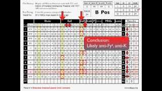 Antibody ID Basic Cases Part 2 [upl. by Ttik]