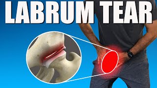 HIP LABRUM TEAR BEST Exercises Stretches amp Advice for Hip amp Groin Pain Relief [upl. by Hubing]