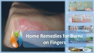 Home Remedies for Burns on Fingers [upl. by Mcferren]