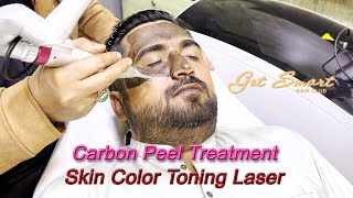 Carbon Laser Facial Treatment for Skin Glow [upl. by Oderfliw]