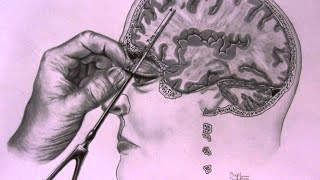 The Most TWISTED Medical Procedure in History  The Lobotomy [upl. by Aelat373]