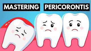 From Identifying To Management  Become An Expert On Pericoronitis [upl. by Bish]