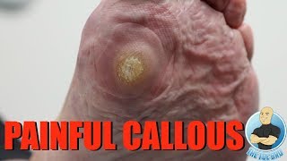 HUGE PAINFUL CALLOUS REMOVAL AND HOW TO STOP IT FROM GROWING [upl. by Mumford]