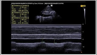 Step by step approach of hypoxic and shock patient by advanced critical care US [upl. by Holtorf]