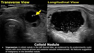 Thyroid Ultrasound Reporting  How To Write USG Scan Reports  Thyroid Pathologies  Small Parts USG [upl. by Bette-Ann]