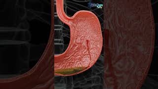 Understanding Hemorrhagic Gastric Ulcers [upl. by Stephenie]