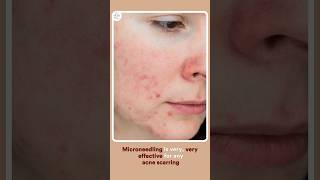 PostAccutane Treatments Reduce Acne Scars with Microneedling amp More [upl. by Iphigeniah276]