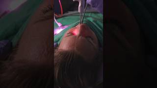 What happens during a balloon sinuplasty balloonsinuplasty nasalcongestion entcare [upl. by Burbank]