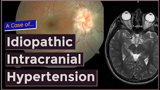 Idiopathic Intracranial Hypertension [upl. by Boswall618]