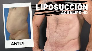 LIPOSUCCIÓN ABDOMEN Y FLANCOS EN HOMBRE MADURO CON DEFINICIÓN [upl. by Ahsiki]