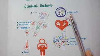 What is infective endocarditis Morphology clinical feastures Dukes criteria [upl. by Schindler]