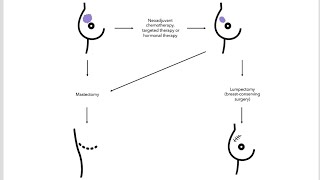 NeoAdjuvant Chemotherapy for Breast Cancer [upl. by Azila]