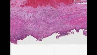 Histopathology GallbladderChronic cholecystitis [upl. by Sitruc]