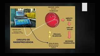 ABLACIÓN POR RADIOFRECUENCIA EN RENAL [upl. by Esmerolda833]