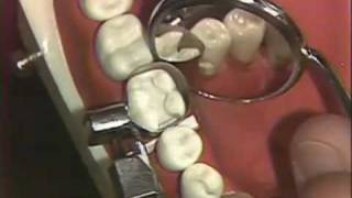 Packing of Class II Amalgam for Hygienists [upl. by Nylyaj718]