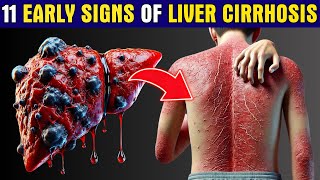 LIVER is DYING 11 Early Warning Signs of Liver Cirrhosis You Cant Ignore  Healthy Care [upl. by Segalman]