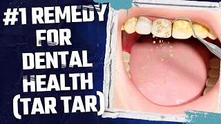 Natural Remedies to Eliminate Dental Plaque Say Goodbye to Tartar Fast [upl. by Ferullo]