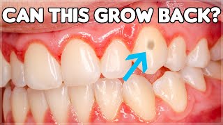 Can Tooth Enamel Grow Back How To Prevent Enamel Erosion [upl. by Norabel]