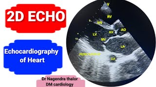 2D Echocardiography of heart Echo test in hindiHeart pumping valvesHole by ECHO [upl. by Ellednahs76]