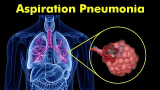 Breathing Trouble Understanding Aspiration Pneumonia [upl. by Marita]