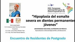 ER32 386 Hipoplasia del esmalte severa en dientes permanentes jóvenes [upl. by Sualkcin]