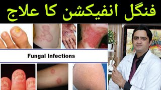 Fungal Infection Treatment  Fungal Infection Ka ilaj  Fungus Ka ilaj in Urdu  Dr umair ishaq [upl. by Ahsimal641]