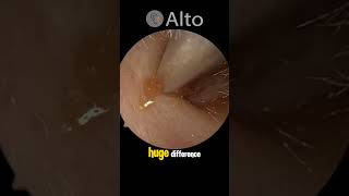 Microsuction Earwax Removal hearinghealth audiology earwaxremoval satisfying healthyhearing [upl. by Hsenid222]