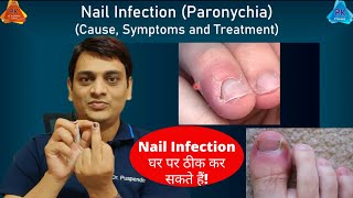 Nail Infection Paronychia  Cause amp Treatment  नाखून संक्रमण का इलाज कैसे करें Dr Puspendra [upl. by Eineeuq]