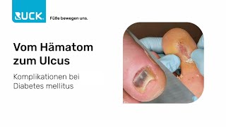 Diabetischer Fuß  vom Hämatom zum Ulcus  Fallbeispiel [upl. by Cesare]