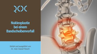 Nukleoplastie bei einem Bandscheibenvorfall  ROC Aschheim [upl. by Stanleigh581]