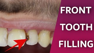 Front Teeth Filling Process  Dentist do front tooth decay repair  Composite bonding restoration [upl. by Yralam]